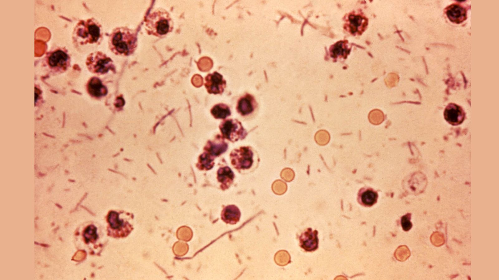 Kochi restaurant under scanner as three Shigella cases confirmed after food poisoning