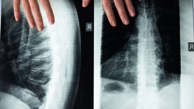 Five-year-old lies on her back for first time after spinal surgery in Delhi